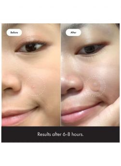 Before and after image demonstrating hydrocolloid patch benefits in 6-8 hours using the Mighty Patch 24 count.