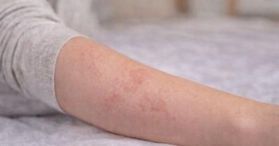 Hives (Urticaria): Symptoms, Causes, and Treatment (Plus When to Worry)